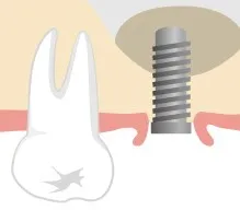 ソケットリフト