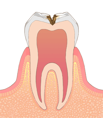 虫歯のC3のイラスト